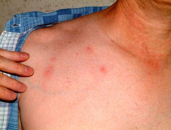 symptoms of parasites under the skin