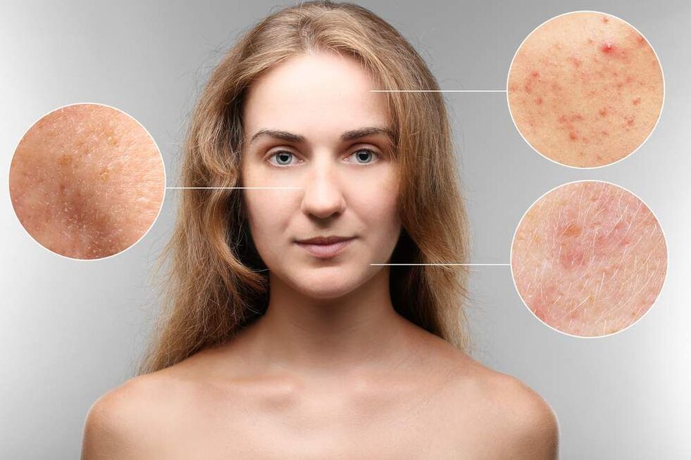 rash on face with parasites