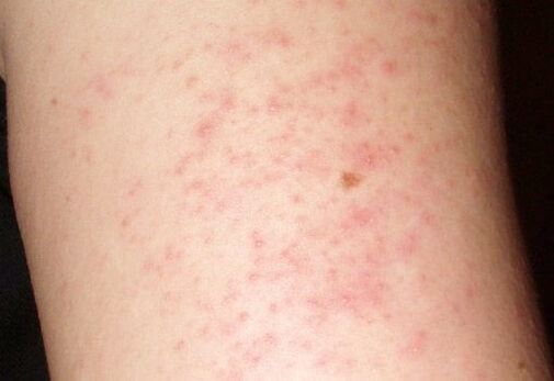 An itchy skin rash - a symptom of the presence of worms in the liver