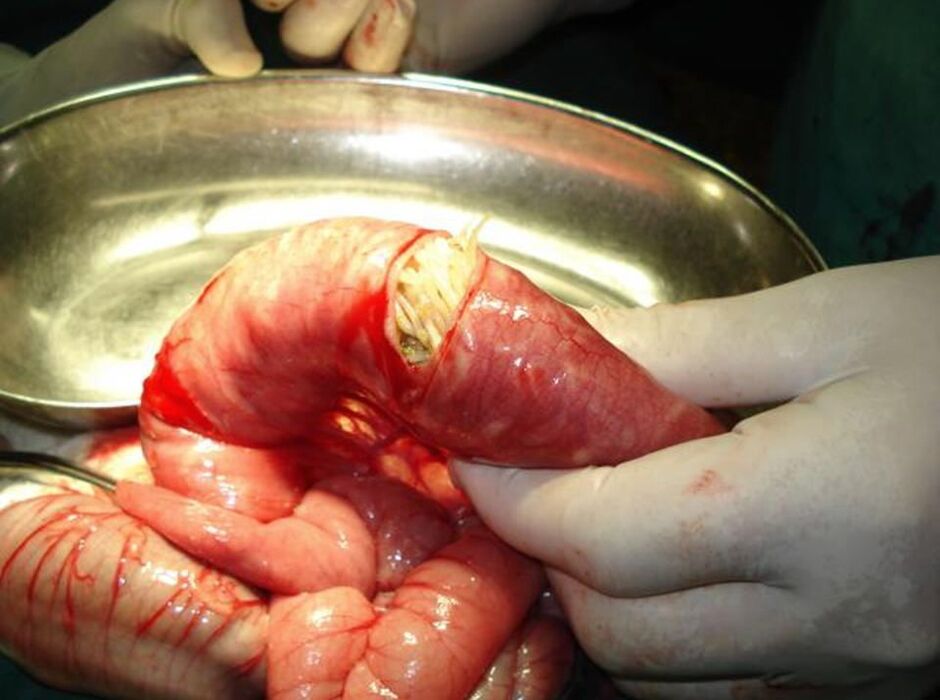 Roundworm in the human intestine